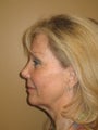 Facelift