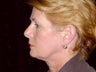 Facelift