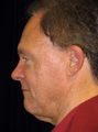 Facelift, Chin Implant, Browlift