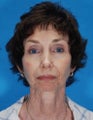 Face Lift and Chin Implant