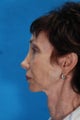 Face Lift and Chin Implant
