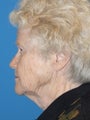 Facelift