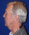 Facelift