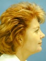 Facelift, Endoscopic Browlift, Upper and Lower Blepharoplasty