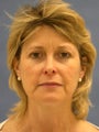 Facelift, Endoscopic Browlift, Upper and Lower Blepharoplasty, Lip Augmentation with Alloderm Grafts
