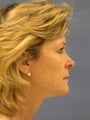 Facelift, Endoscopic Browlift, Upper and Lower Blepharoplasty, Lip Augmentation with Alloderm Grafts