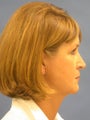 Facelift,Endoscopic Browlift, Upper and Lower Bleparoplasty, Lip Augmentation with tissue grafts, perioral dermabrasion