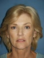 Facelift, Endoscopic Browlift, Upper and Lower Blepharoplasty, Lip Augmentation with Fat injections