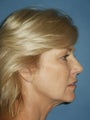 Facelift, Endoscopic Browlift, Upper and Lower Blepharoplasty, Lip Augmentation with Fat injections