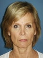 Facelift, Endoscopic Browlift, Upper and Lower Blepharoplasty, Perioral Dermabrasion
