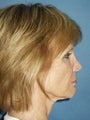 Facelift, Endoscopic Browlift, Upper and Lower Blepharoplasty, Perioral Dermabrasion