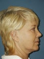 Facelift, Endoscopic Browlift, Upper and Lower Blepharoplasty with canthopexy, Perioral and Glabellar Dermabrasion