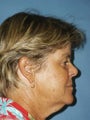 Facelift, Endoscopic Browlift, Upper and Lower Blepharoplasty, Lip Augmentation with Fat injections