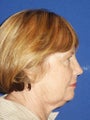 Facelift, Endoscopic Browlift, Upper and Lower Blepharoplasty, Perioral Dermabrasion
