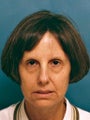 Facelift, Endoscopic Browlift, Bilateral Lower Blepharoplasty