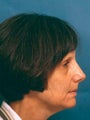 Facelift, Endoscopic Browlift, Bilateral Lower Blepharoplasty