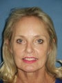 Facelift, Endoscopic Browlift, Upper and Lower Blepharoplasty with canthopexy, soft tissue fillers to the lips