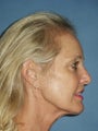 Facelift, Endoscopic Browlift, Upper and Lower Blepharoplasty with canthopexy, soft tissue fillers to the lips