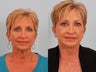 Facelift
