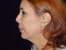 Face lift, brow lift, eyelid lift