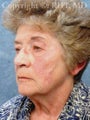 Forehead lift, SMAS facelift, platysmaplasty, upper and lower eyelid lifts