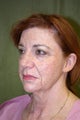 Facelift