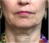 Lower facelift, necklift, CO2 laser resurfacing