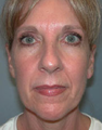 Facelift