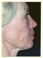 Facelift