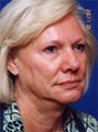 Facelift