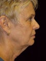 Lower Face lift