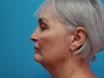 Facelift