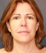 Facelift and laser resurfacing