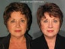 Facelift