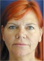 Facelift