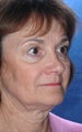 Facelift
