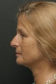 Facelift