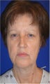 Facelift, Neck lift, Browlift, Lower Blepharoplasty (eyelid lift)