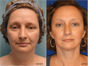 Facelift, Neck liposuction and lift, Endoscopic Browlift, Upper Blepharoplasty (eyelid lift)