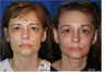 Facelift, Necklift, Browlift Lower Blepharoplasty (eyelid lift), Laser scar/facial resurfacing