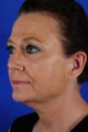 Facelift