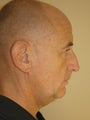 Facelift, Fat Injection, Neck Lift