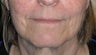 "Liquid facelift" with filler