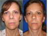 Facelift, Neck lift, Browlift, Upper and Lower Blepharoplasty (eyelid lift)