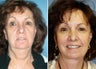 Faceilft and platysmaplasty
