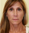 facelift