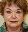 facelift