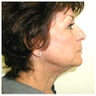 Upper and lower eyelids / face and neck lift and brow lift.