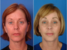 Facelift