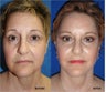 Facelift, necklift, lower blepharoplasty, browlift